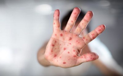 شیوع سرخکان در قندوز ـ هفده طفل جان باخت