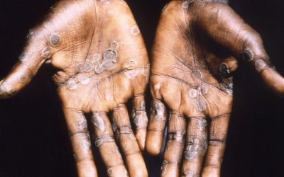 ثبت موارد مشکوک به آبله میمون در کابل