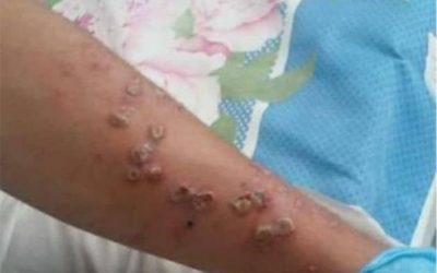 پای آبله میمون به نیمروز باز شد