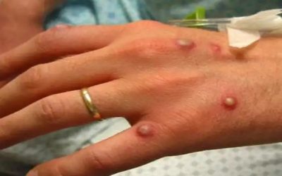 اولین مورد آبله میمون در هرات ثبت شد